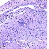 Minimally invasive autopsy for cause of death determination in high ...