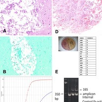 Minimally invasive autopsy for cause of death determination in high ...